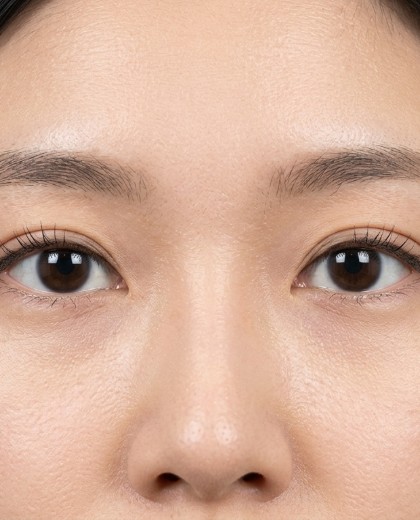 小雯 双眼皮术后