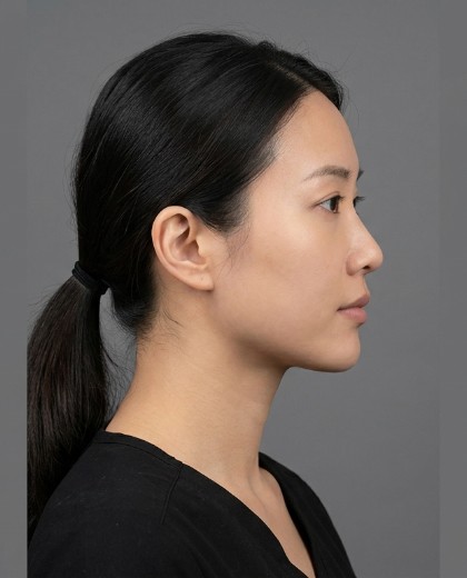 Rachel 去双下巴术后